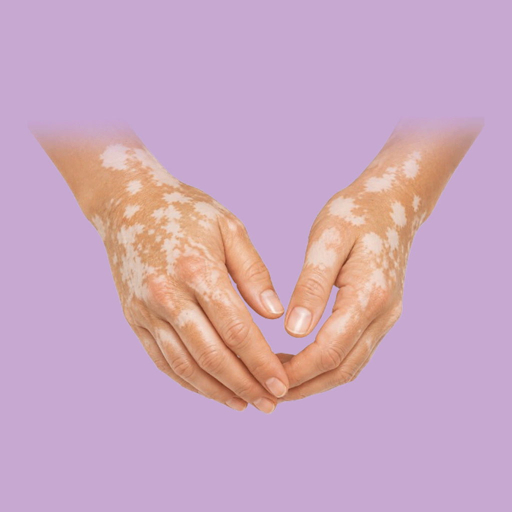 Vitiligo Treatment